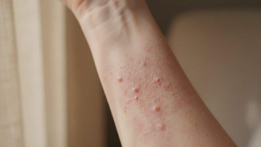 peau atopique qu’est ce que cela signifie réellement